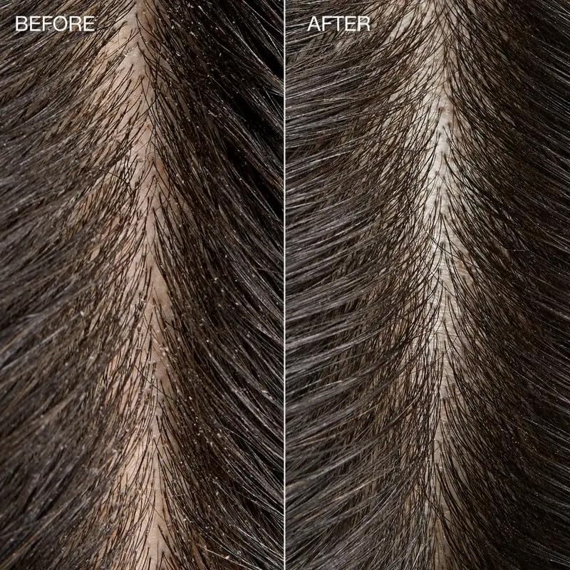 Tea Tree Detox Scrub foam applied to the scalp during treatment.