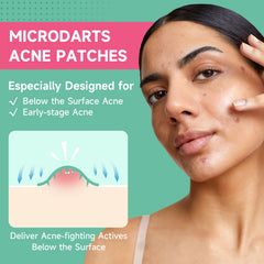 TEAWOO Microdart patches on skin targeting blemishes for acne care.