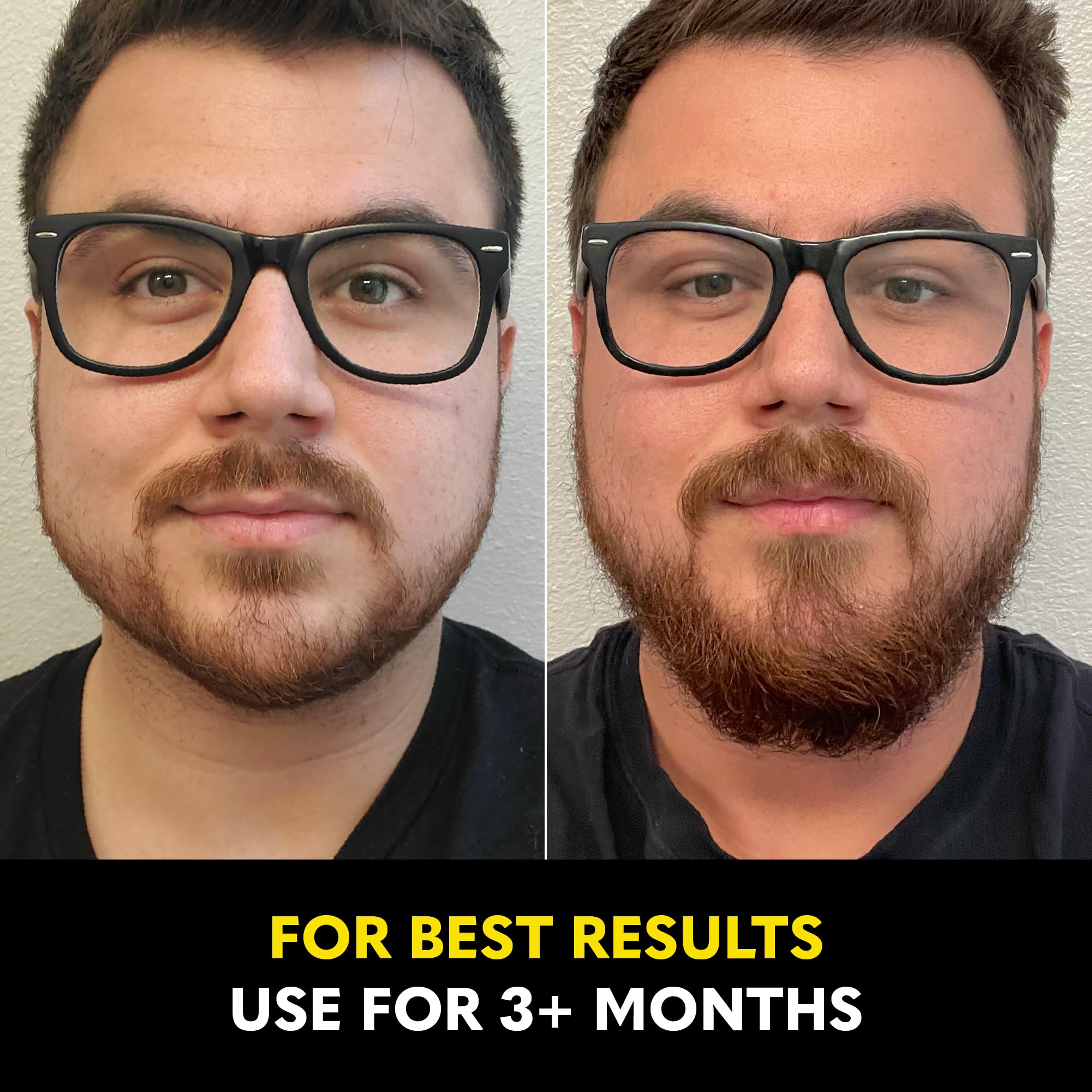 Beard skin beneath hair remains hydrated after Growth Oil use.