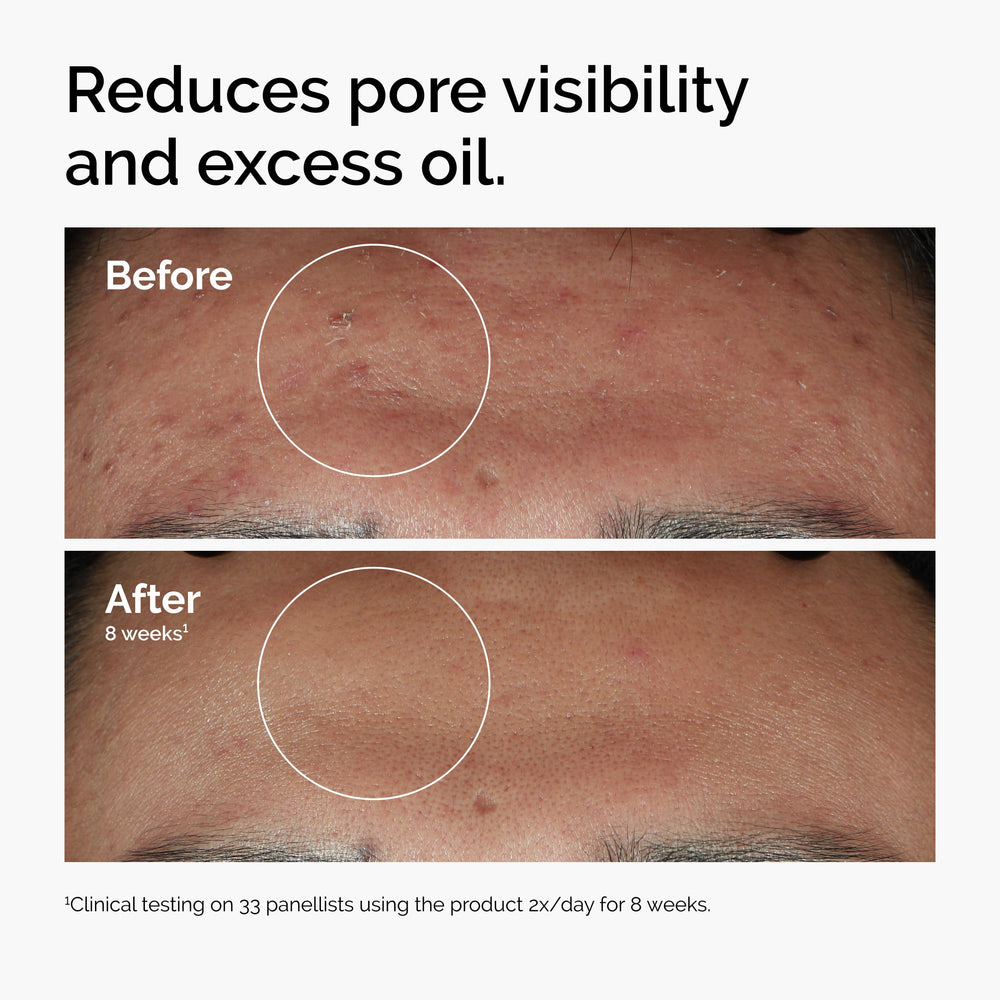The Ordinary Niacinamide 10% + Zinc 1% serum dropper for precise application and pore refinement.