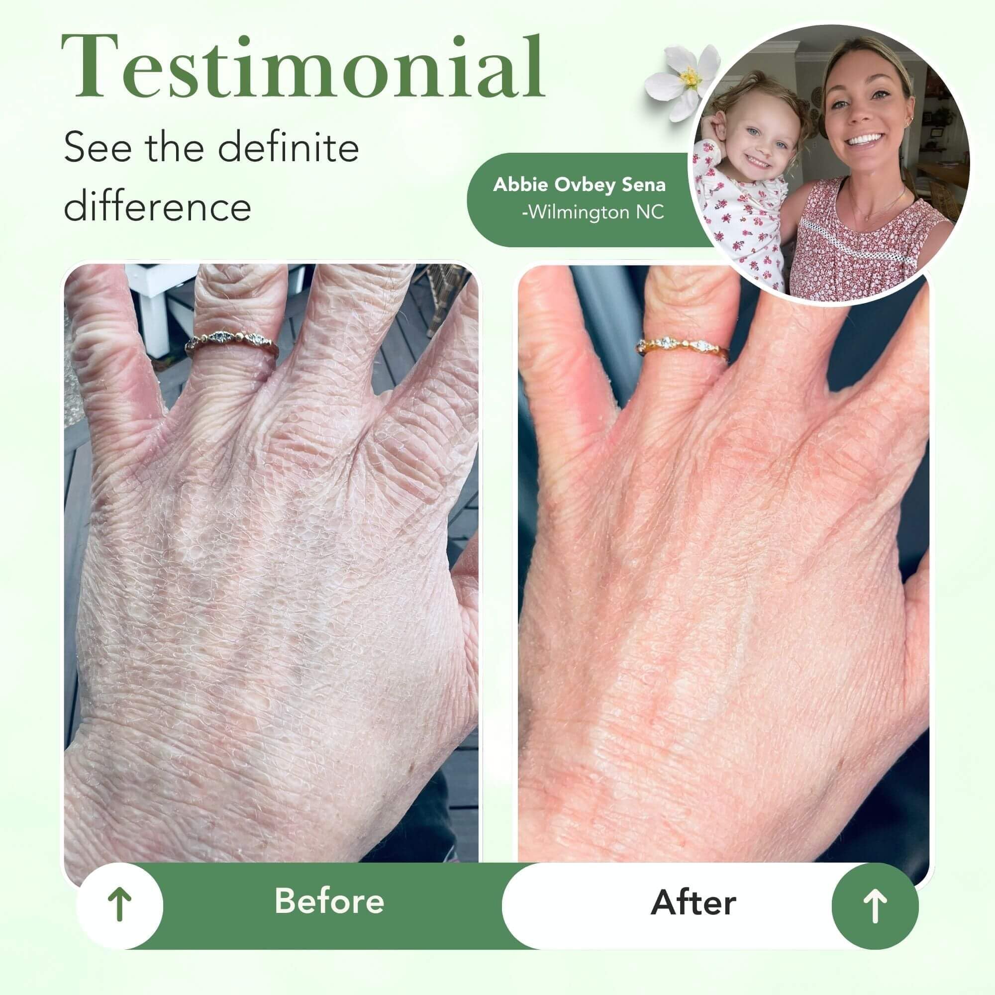 Theraplex balm application on skin demonstrates easy use on dry areas.