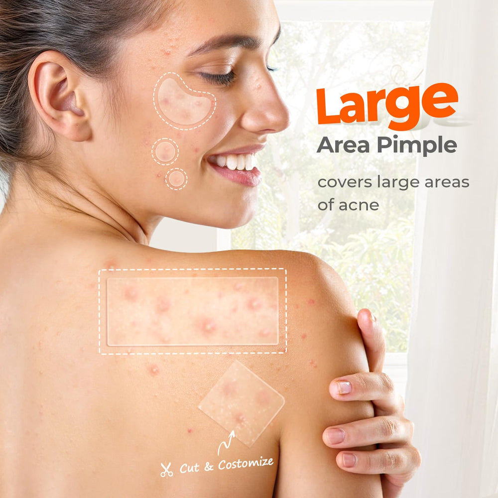 TKTK hydrocolloid patch absorbing oil and pus on the skin.