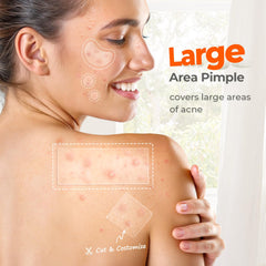 TKTK hydrocolloid patch absorbing oil and pus on the skin.