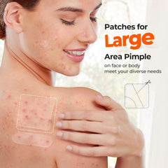 TKTK 12mm dot patch on a blemish gently absorbs fluids overnight