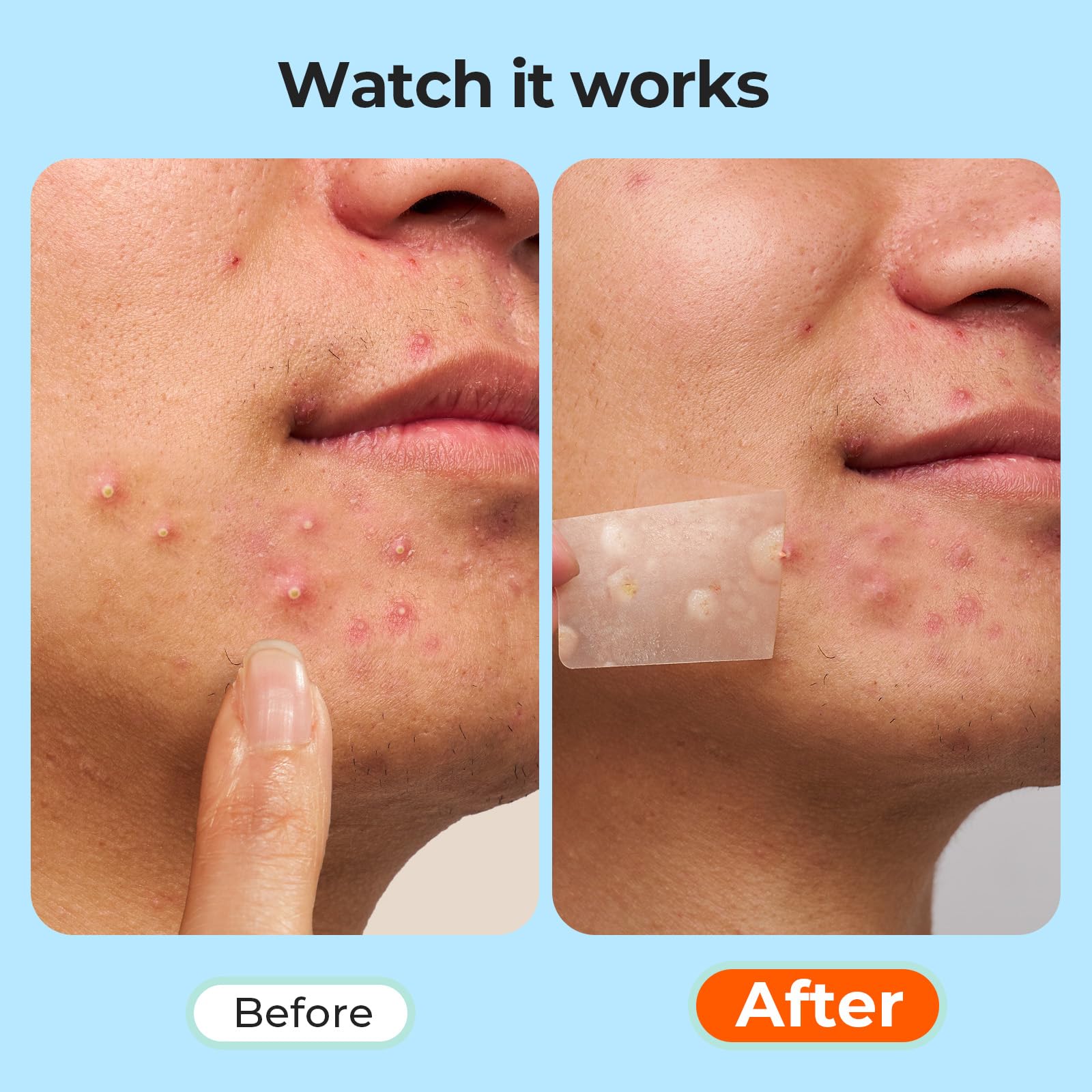 TKTK hydrocolloid patches no additives packaging for sensitive skin