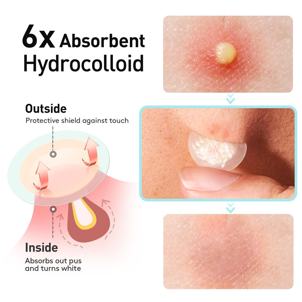 Parche hidrocoloide absorbente de TKTK para pústulas y granos.