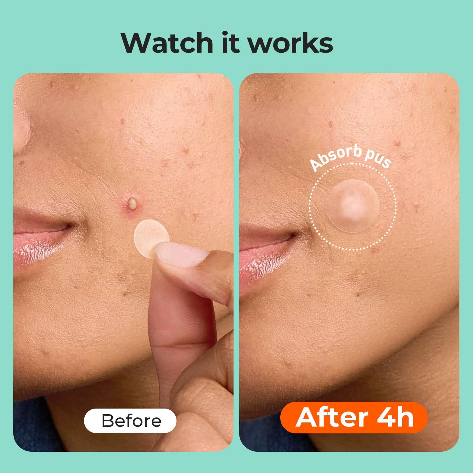 TKTK pimple patch 12mm for larger zits, effective coverage