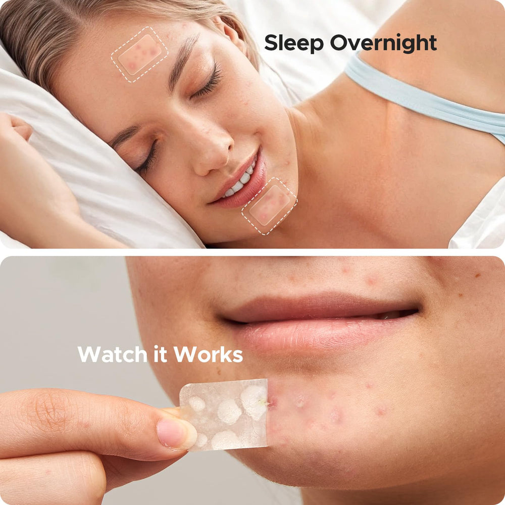 TKTK pimple patches 8mm for precise treatment of tiny spots.