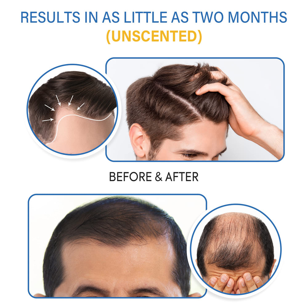 TOMUM Minoxidil Foam supports the receding hairline for a balanced look.
