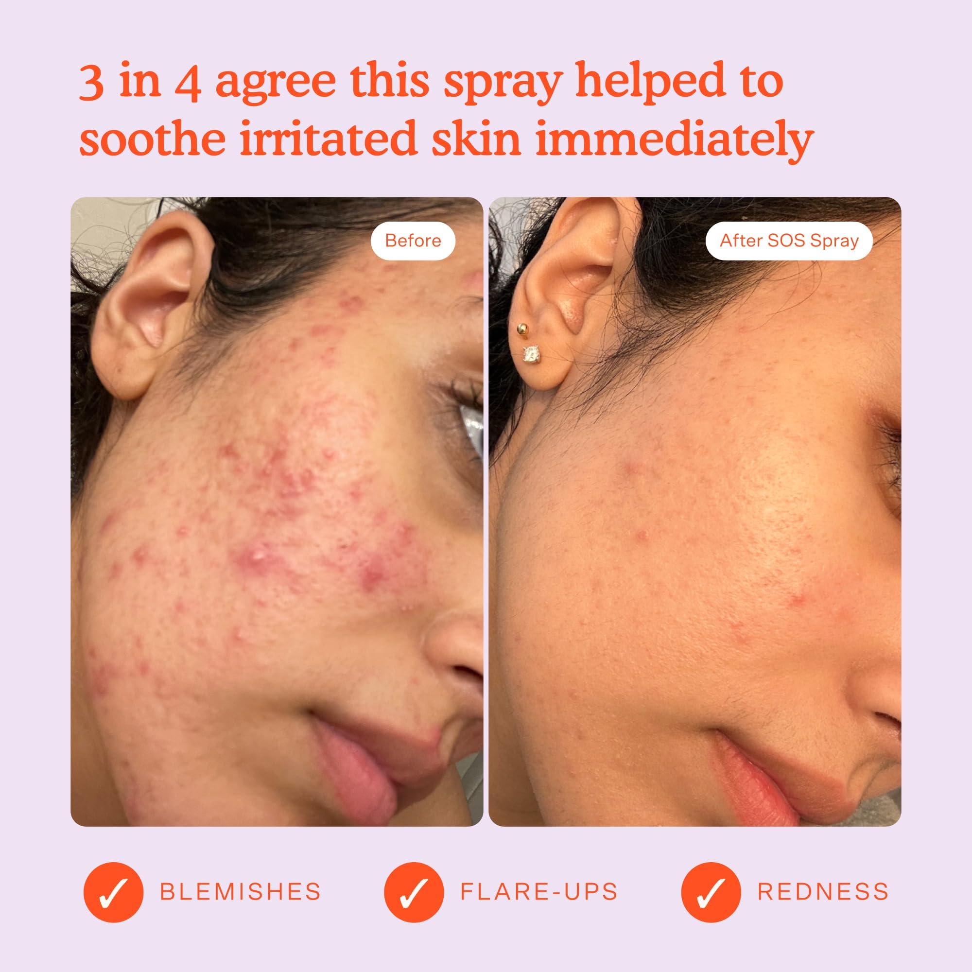 Tower 28 Jumbo SOS Daily Rescue application on face for calming effect