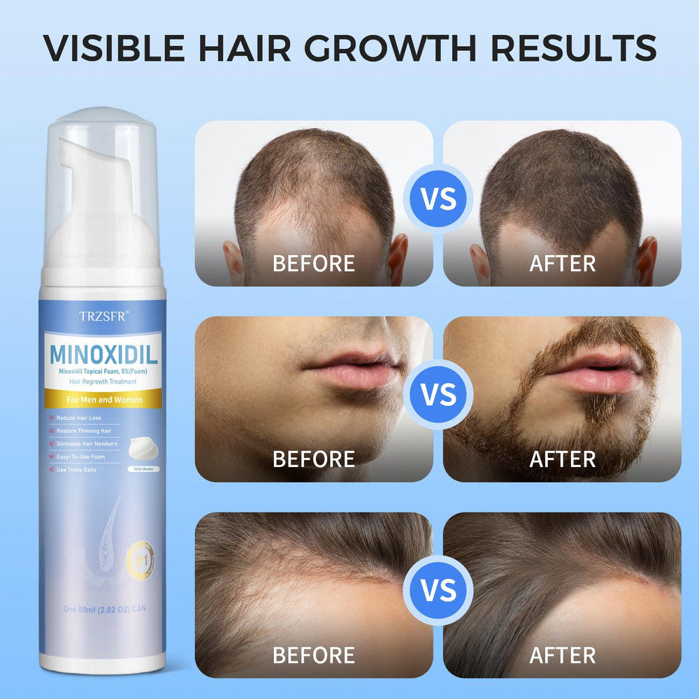 Trzsfr 5% Minoxidil foam on beard area for growth support