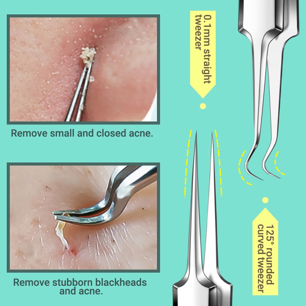 TsMADDTs blackhead extractor tools designed for safe, effective pore clearing.