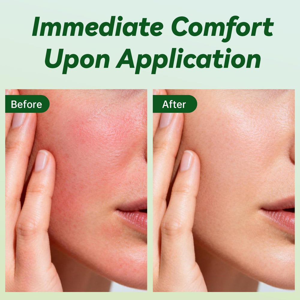 ULARCS Triamicinolona Cream jar closeup highlighting creamy texture for all skin types.