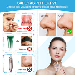 UWOIST blackhead remover tweezers for precise nose extractions