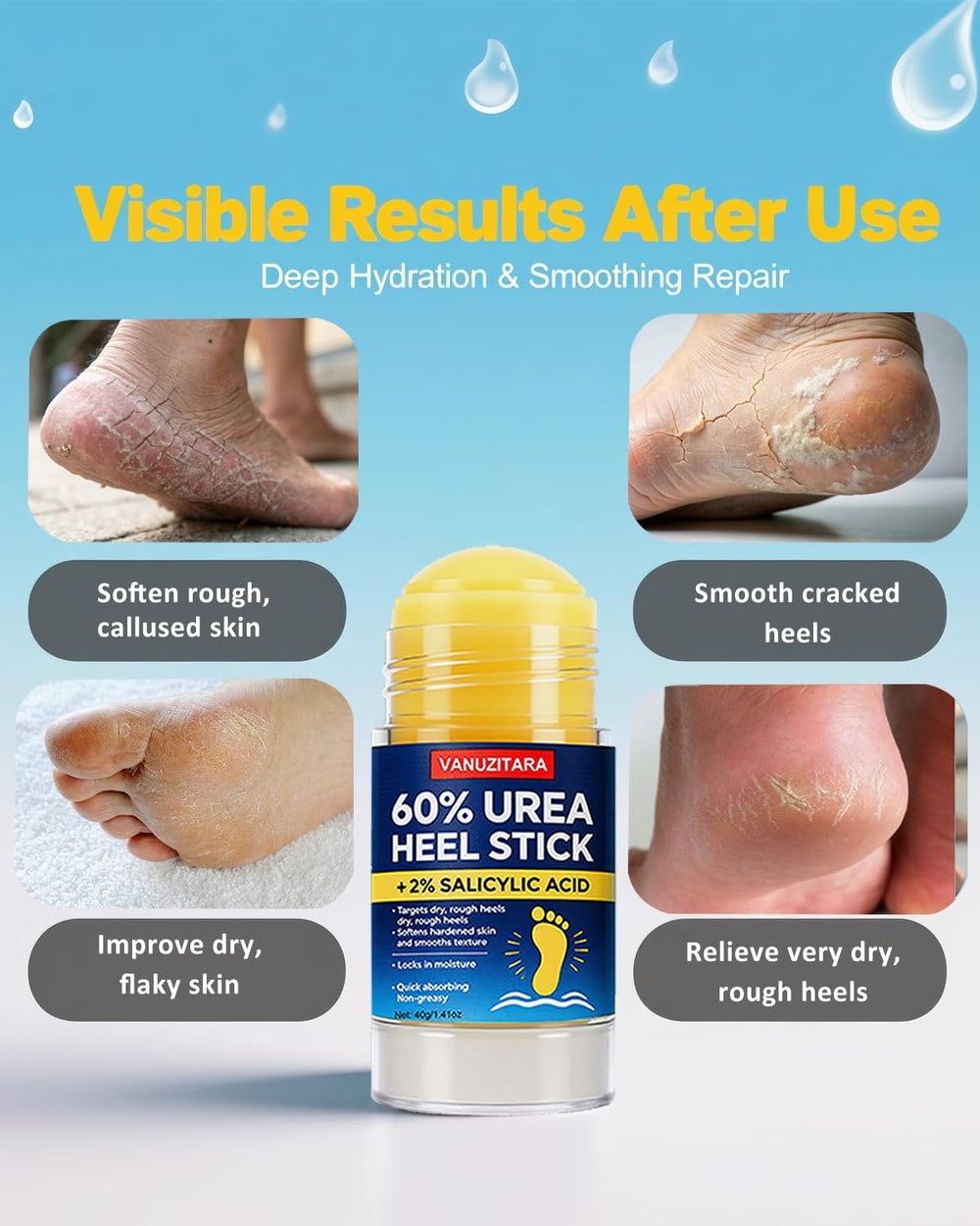 VANUZITARA Urea Cream 60% foot care usage on dry heels and elbows.