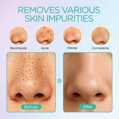 VOYOR small suction head targets stubborn blackheads on the nose.