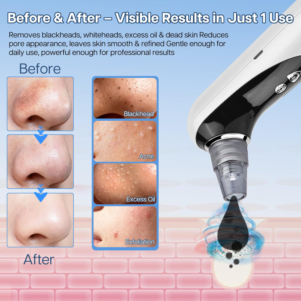 WillowGlow extractor tool close-up for precise sebaceous removal