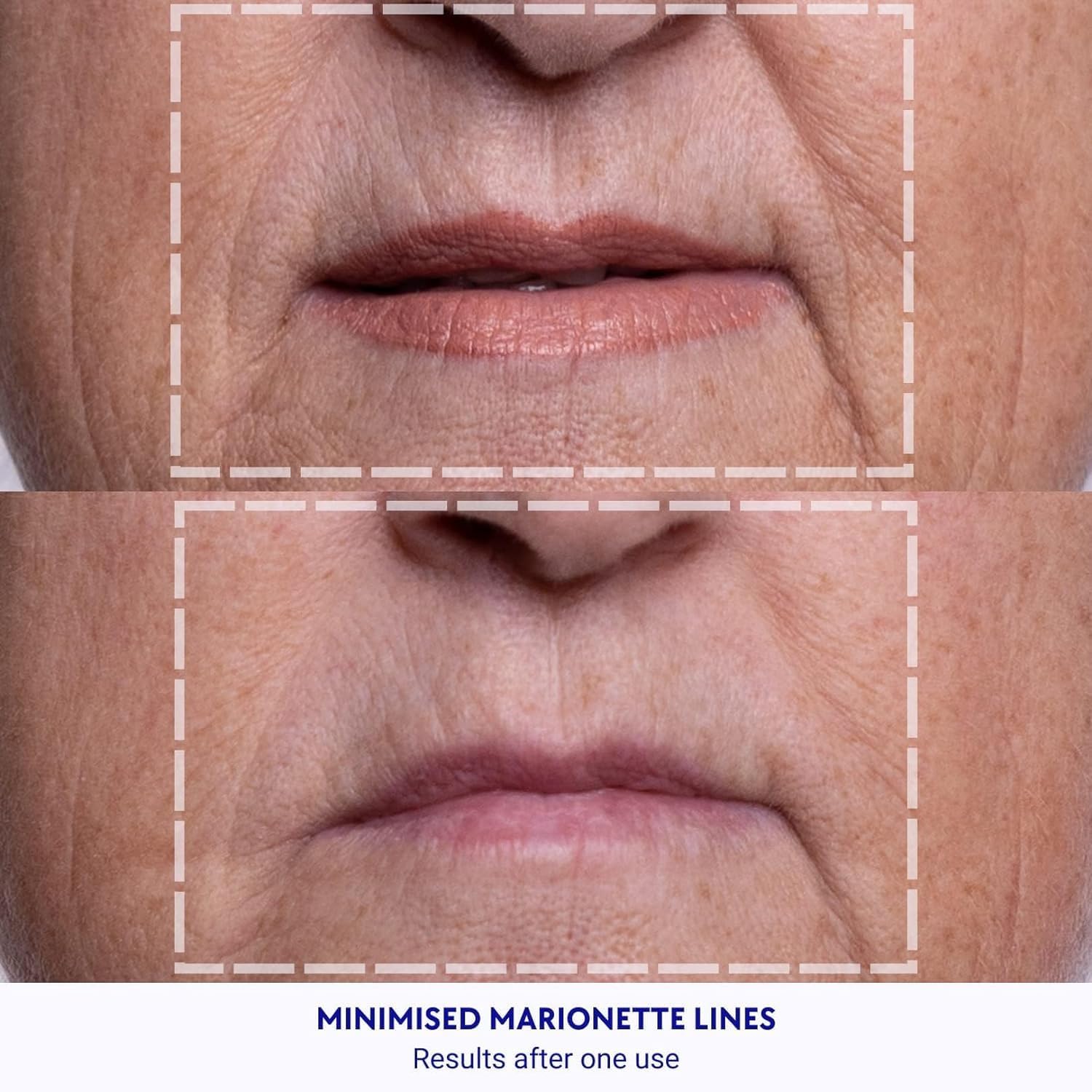 Wrinkles Schminkles Forehead Wrinkle Patches smoothing brow lines for a calmer forehead