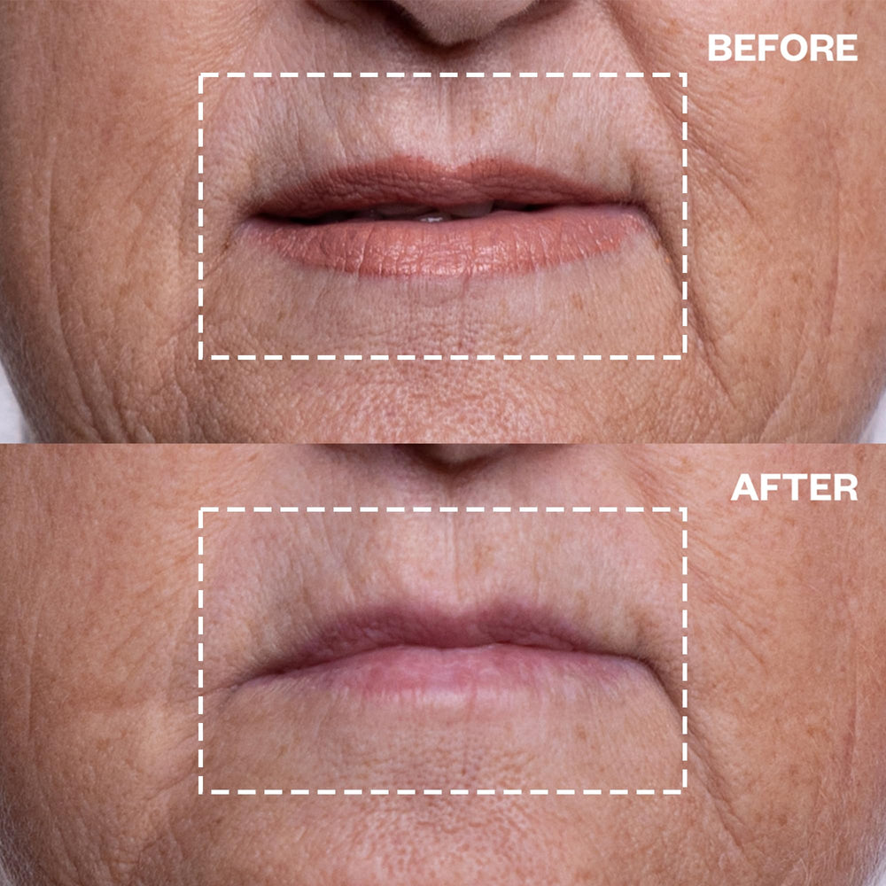 Wrinkles Schminkles marionette-lines patch targets fine lines for improved contour