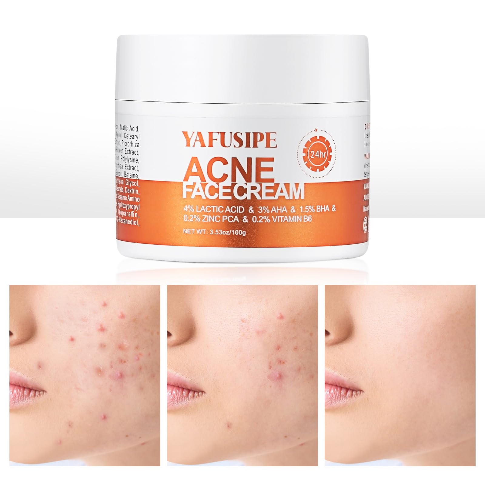 La crema YAFUSIPE Acne Frasco ayuda a limpiar poros y calmar la piel sensible.