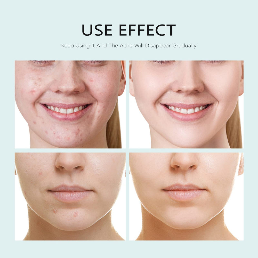 YAFUSIPE mascarilla acne aplicacion rostro para alivio suave y refrescante.