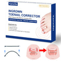 Yanxifei Nitinol Ingrown Toenail Corrector — At-Home Treatment Kit (1/2 in & 11/16 in)