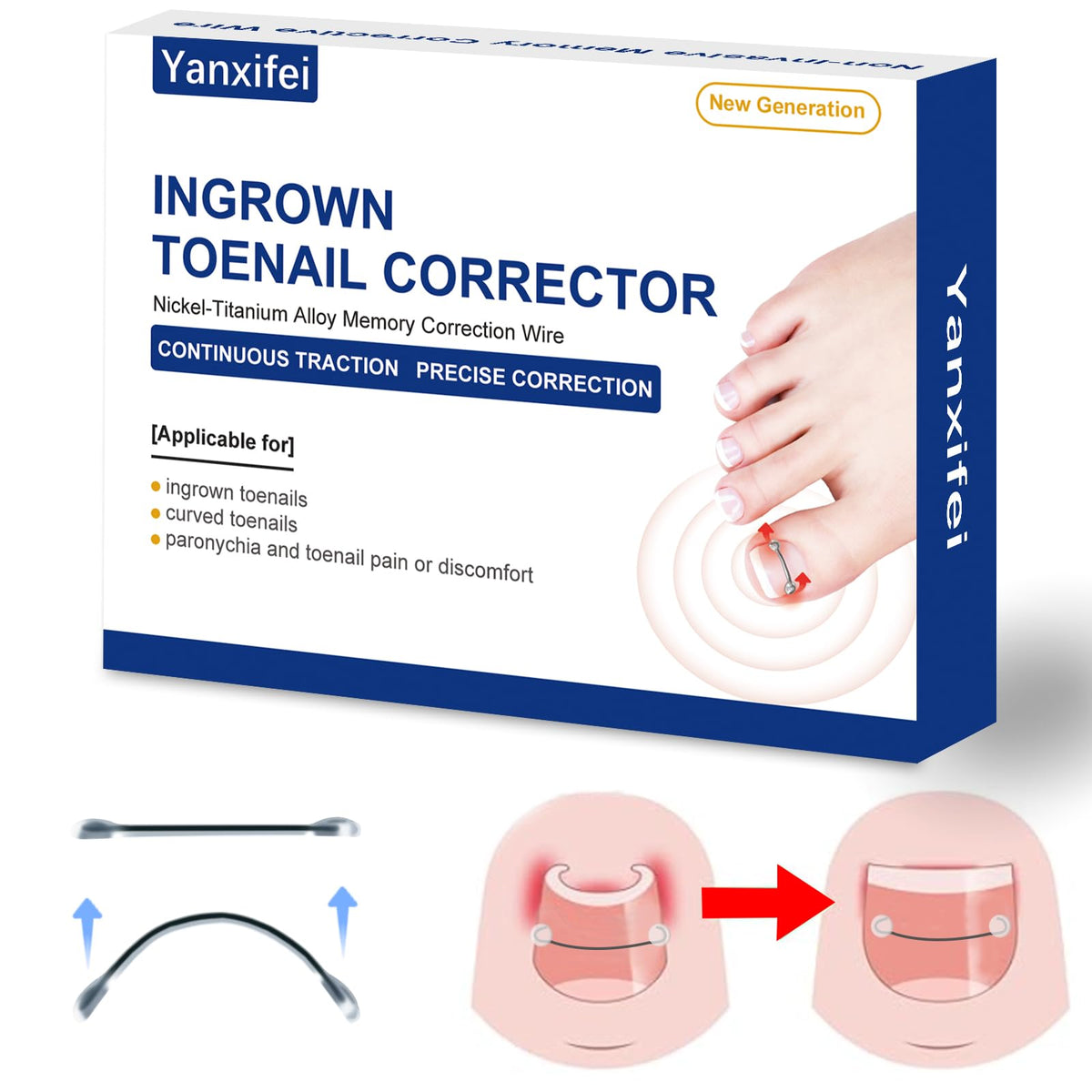 Yanxifei nitinol ingrown toenail corrector half-inch in use gently elevating the nail
