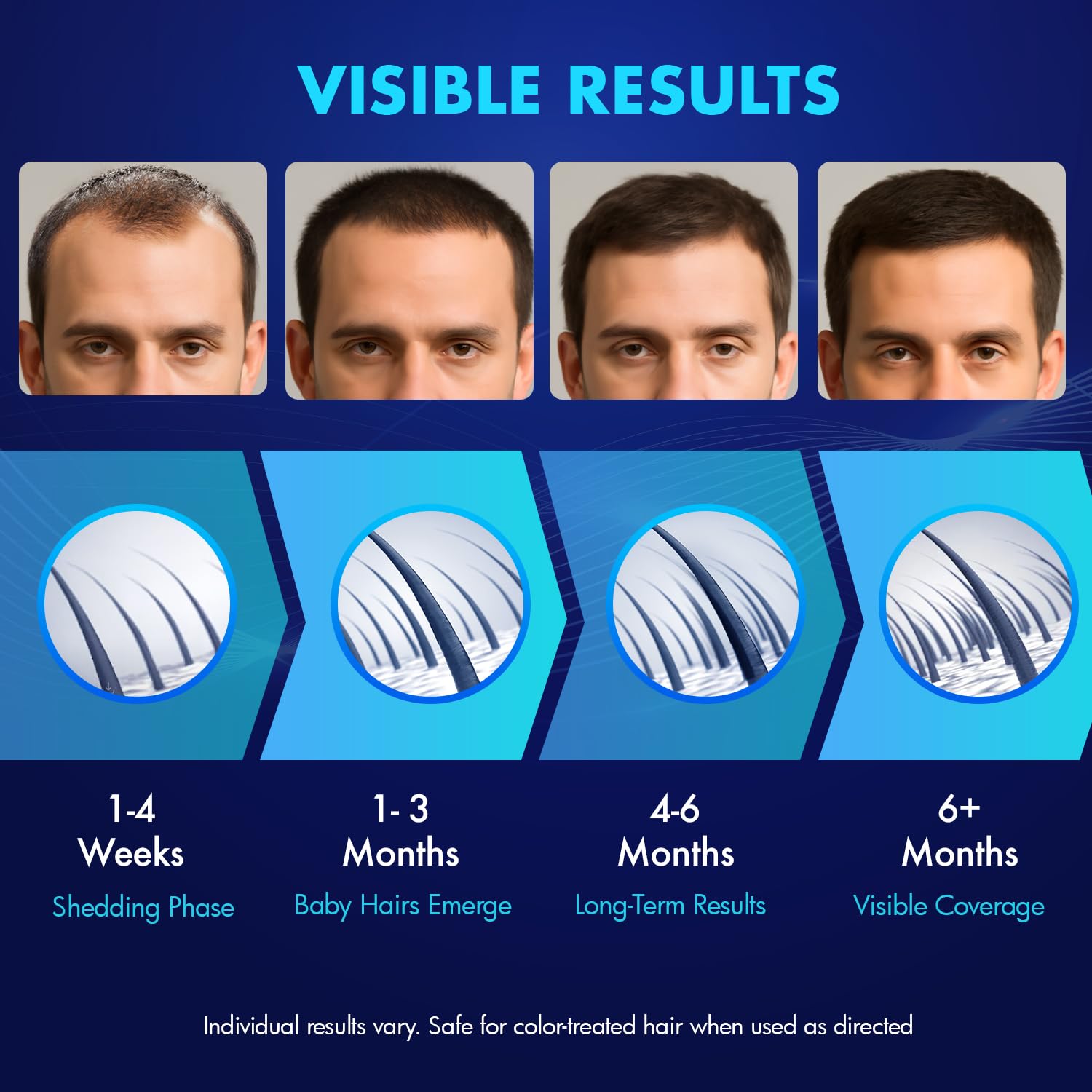 Minoxidil de YIIORAUP con biotina para el cuidado del cuero cabelludo