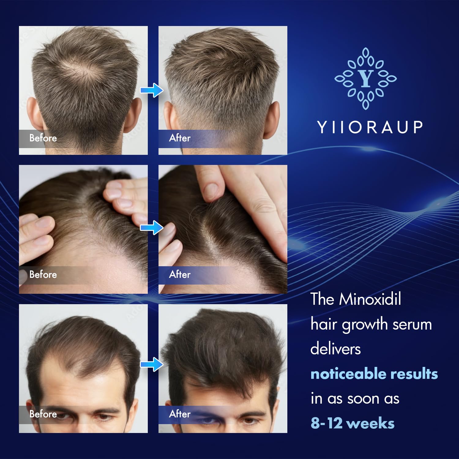 Formula sin olor de YIIORAUP Minoxidil para uso diario cómodo