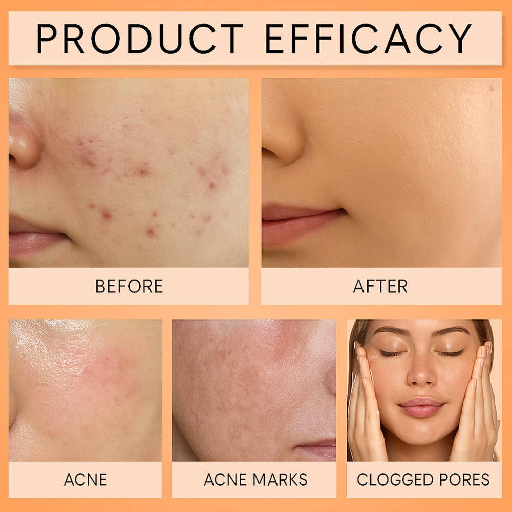 YOCMIPS Organics Acne Balm Set product lineup with natural botanicals for skin care.