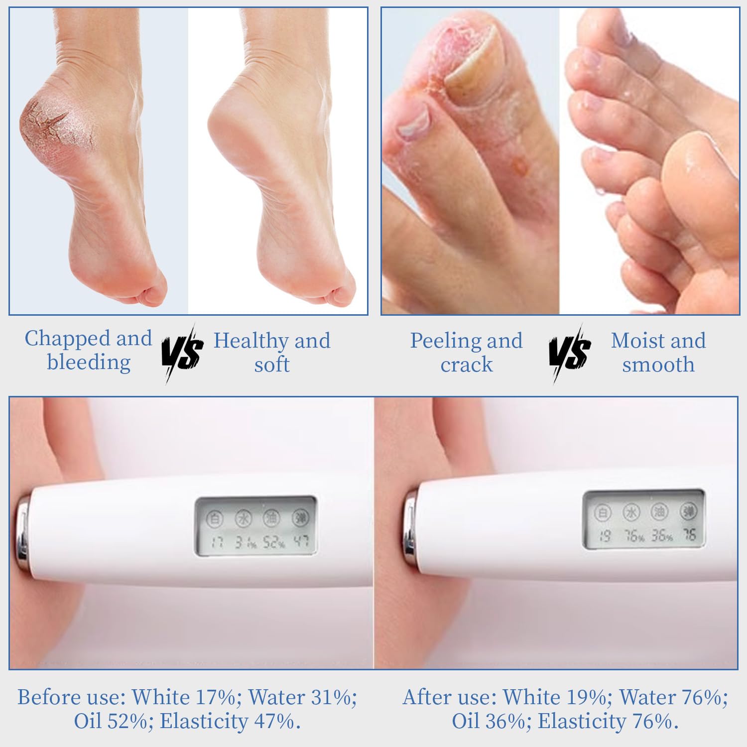 YOUNGYOUNGLOVE crema de urea 70% con aroma fresco, sensación de limpieza