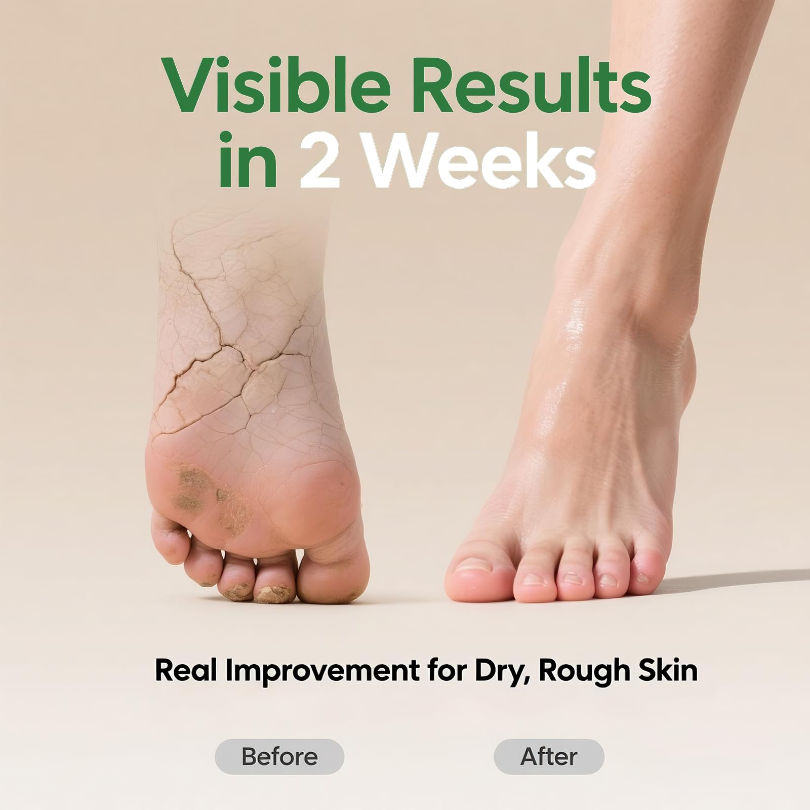 ZyraGloz crema Urea 60% para codos, piel más lisa.